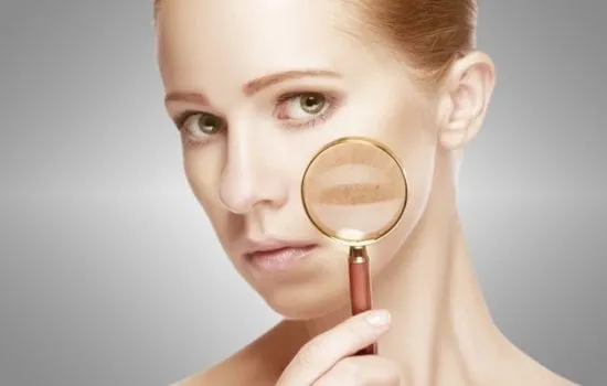 melasma
