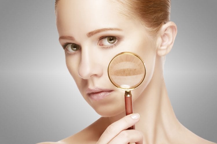 melasma