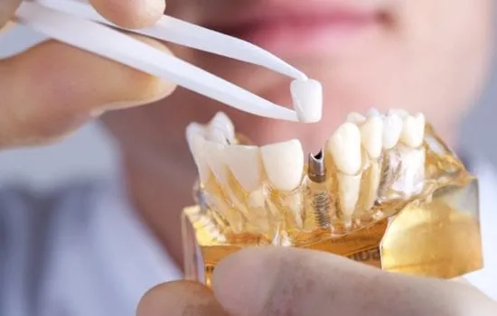 implantes