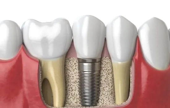 implantes